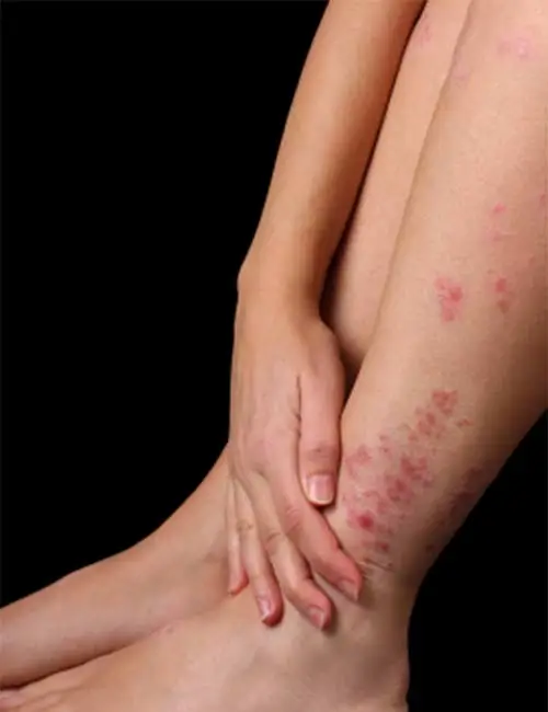 Psoriasis Treatment Chandler AZ