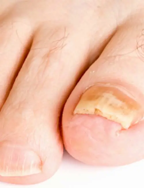 Nail Disorder Treatment Chandler AZ