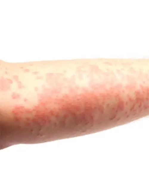 Skin Rash Treatment Chandler AZ