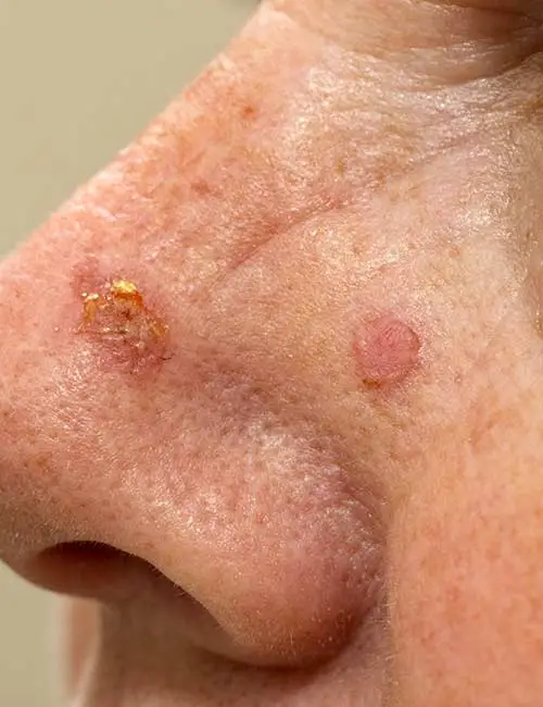 Actinic-Keratosis-Treatment