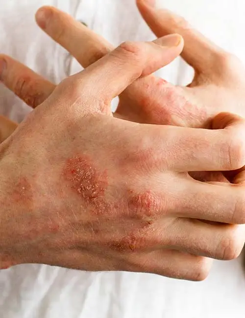 Eczema-Treatment