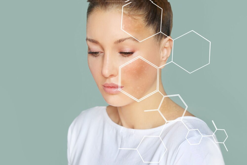 Woman with uneven skin tone and discoloration on her cheek, overlaid with hexagon graphics representing skin analysis or skincare science. [Skin Care}