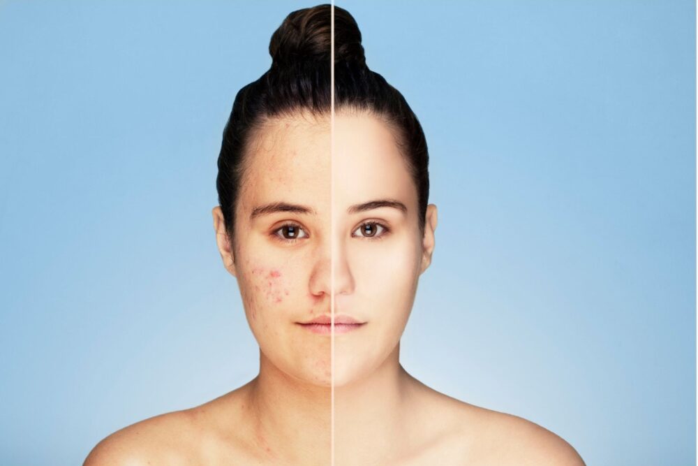 A woman is shown with acne. The image is split vertically down the middle: the left side shows active acne, redness, and blemishes, while the right side appears clear, smooth, and evenly toned, highlighting a before-and-after skin transformation.