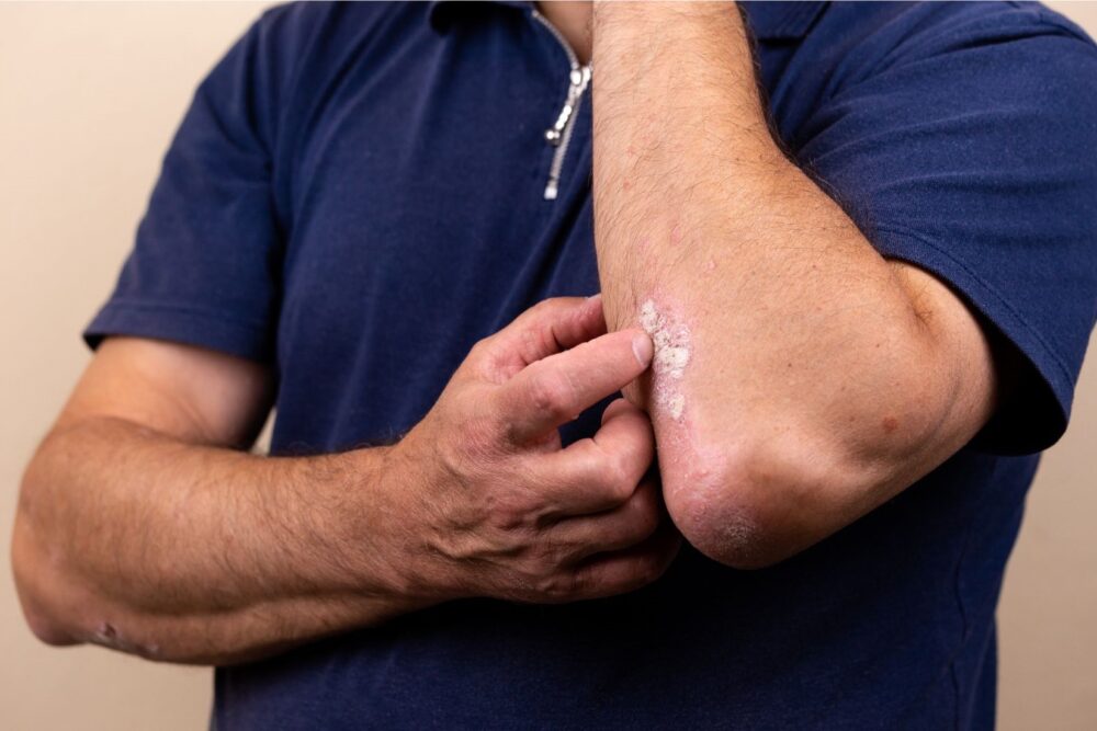 Man scratching red, scaly psoriasis patch on elbow, showing typical symptoms of chronic plaque psoriasis