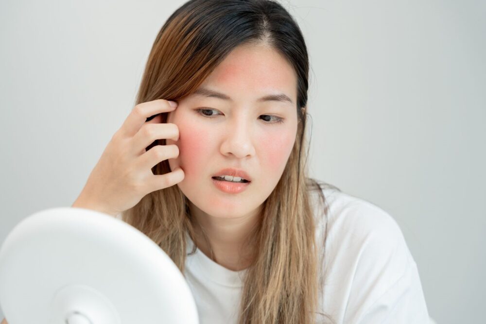 Woman examining red, irritated skin on her cheeks and forehead, showing common symptoms of rosacea flare-up.